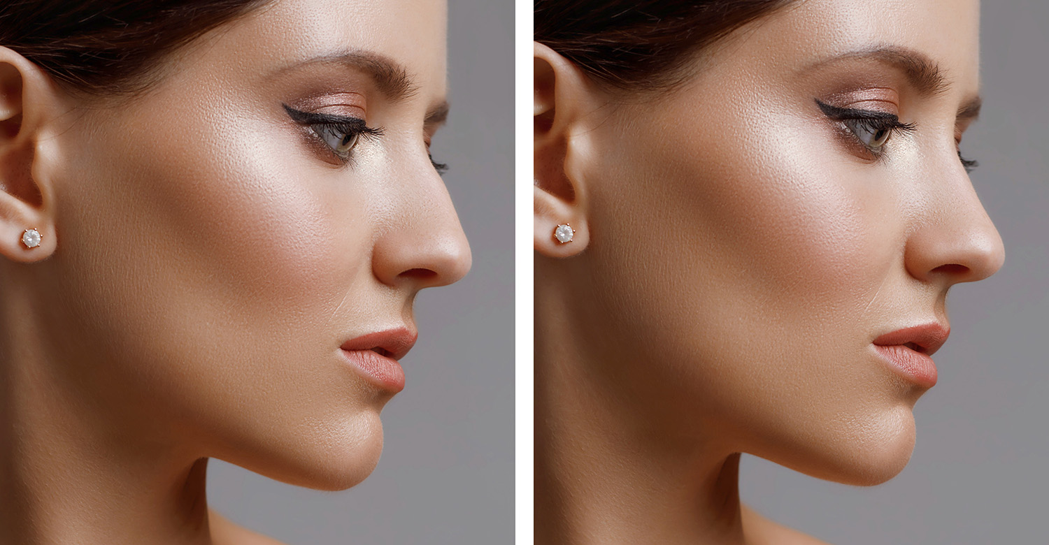 Closeup of Rhinoplasty before and after