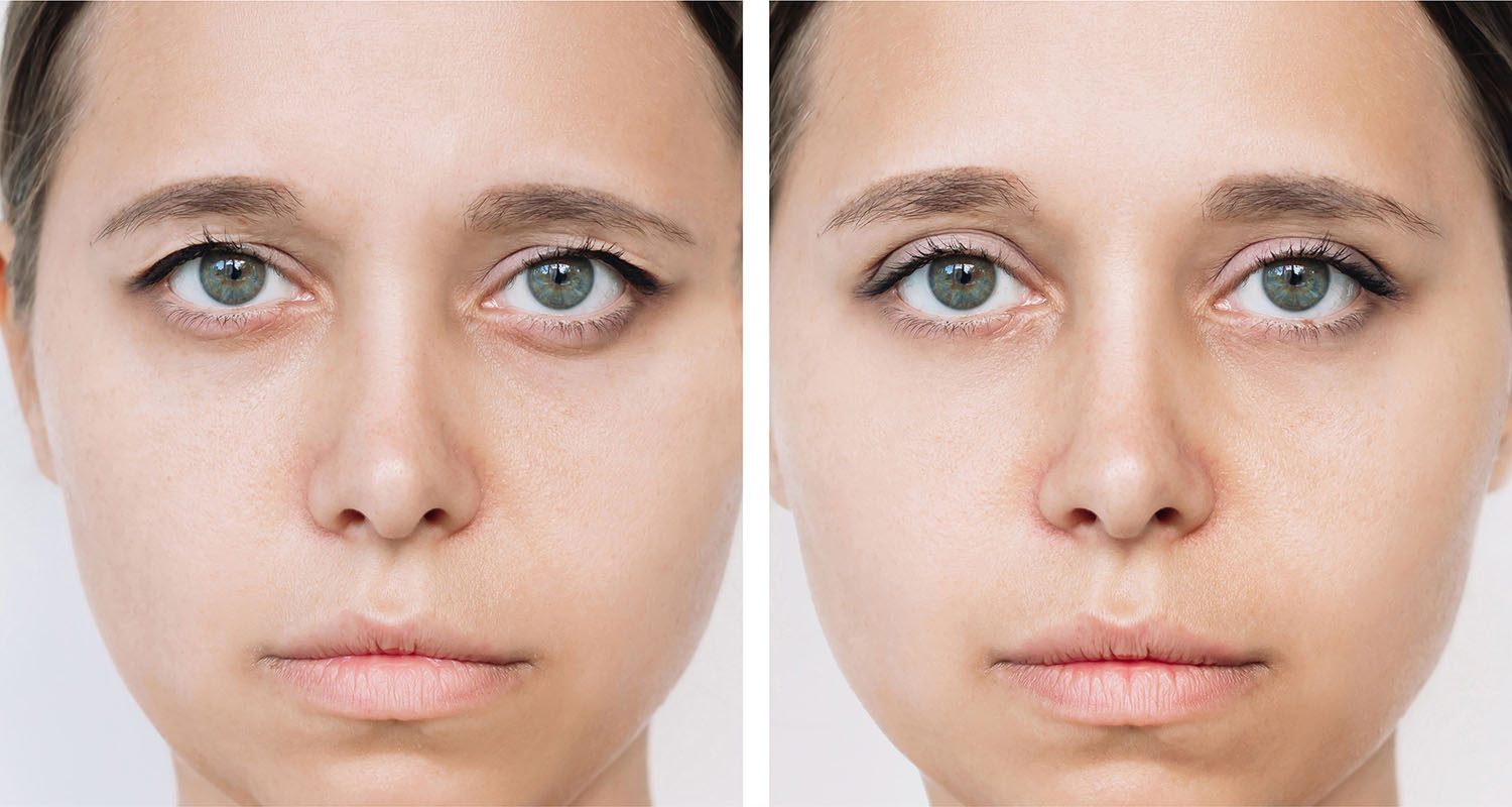 blepharoplasty before and after