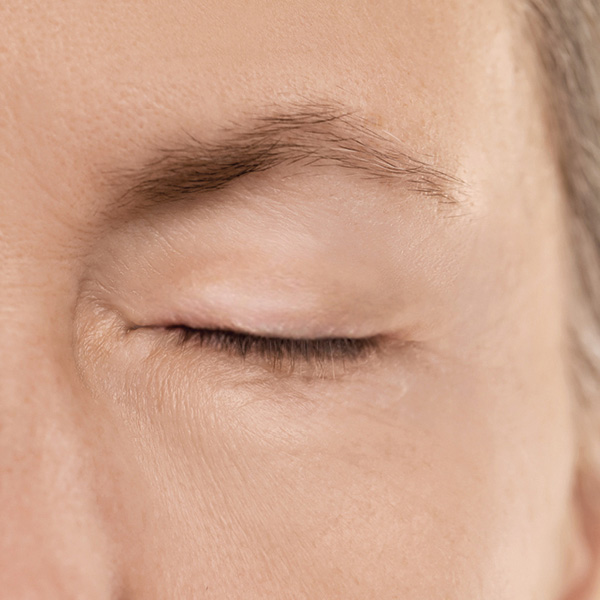 blepharoplasty after