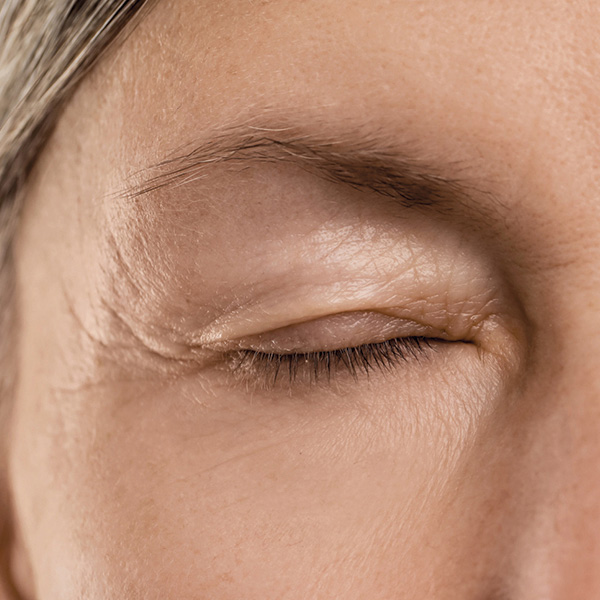 blepharoplasty before