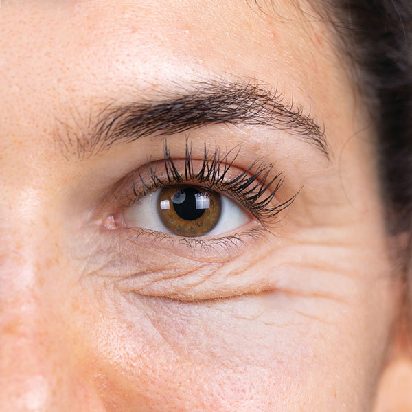 blepharoplasty before